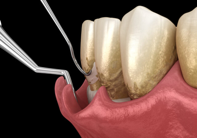 https://www.docteur-helie.fr/wp-content/uploads/2024/05/shutterstock_2018144249-1-640x448.jpg